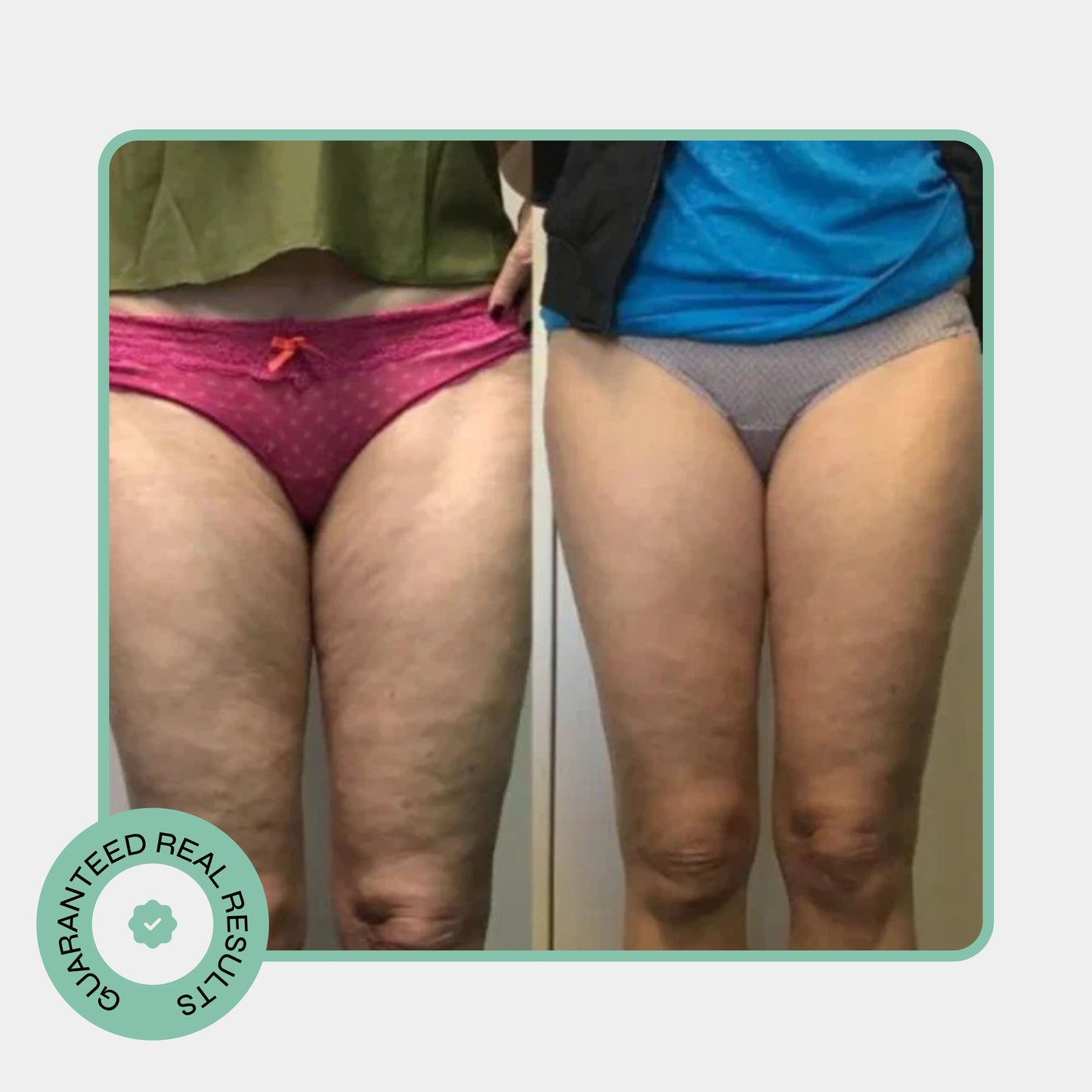 Noko Pro Cellulite Roller