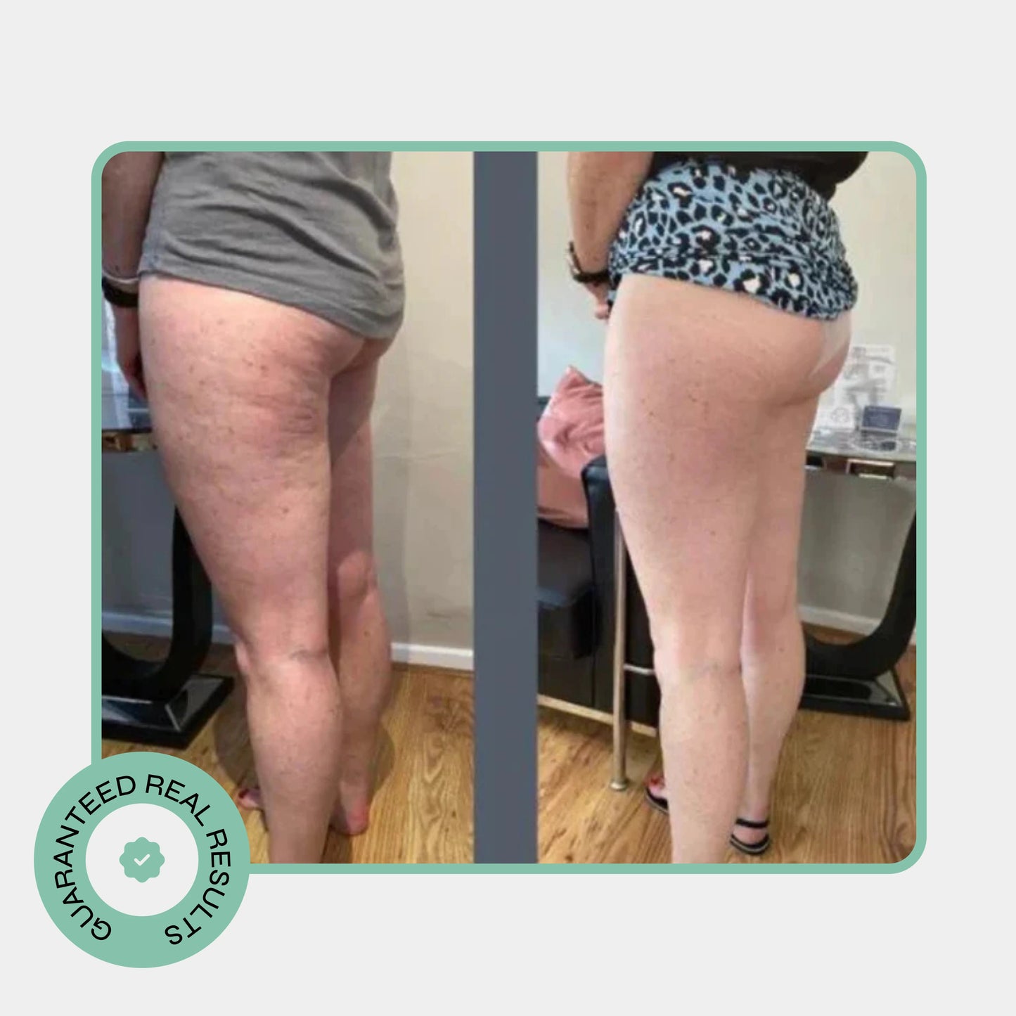 Noko Pro Cellulite Roller